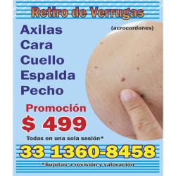 Retiro de Verrugas en cara cuerpo y extremidades