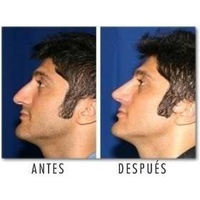  Si buscas 1par De Corrector Nasal Rulav Nariz Bella 30seg Sin Cirugia puedes comprarlo con MULTI COMPRAS está en venta al mejor precio