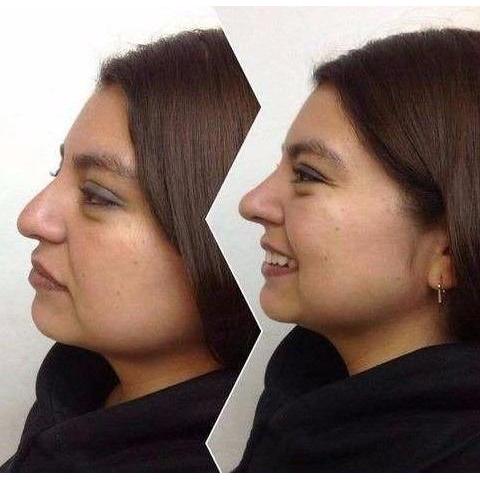  Si buscas 10 Corrector Nasal Rulav Respingador De Nariz Envio Gratis puedes comprarlo con VEROS38 está en venta al mejor precio